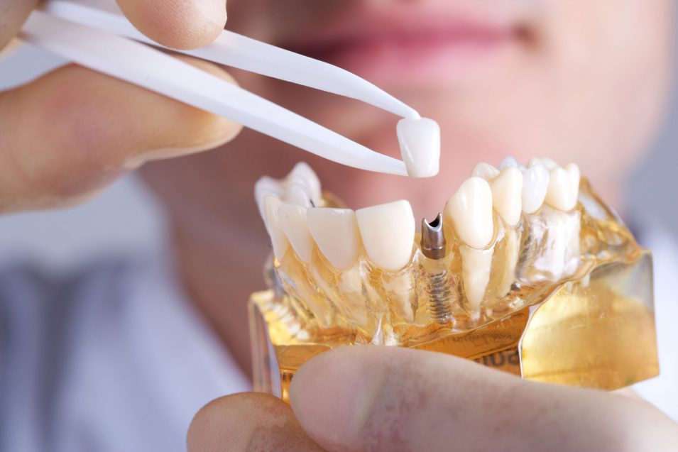 How dental implants work